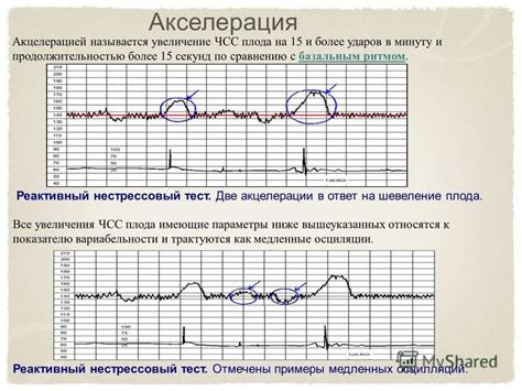 Акселерация 0 на ктг: причины и возможные последствия