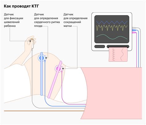 Акселерация 0 на ктг и ее связь с плодовой активностью