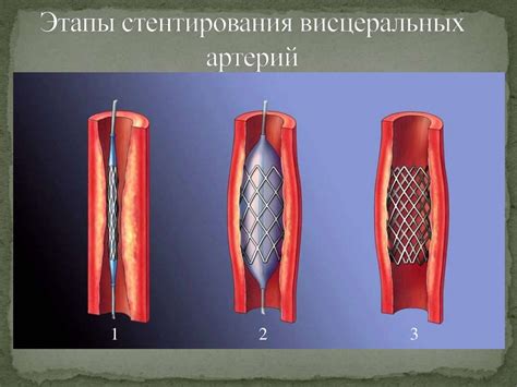 Альтернативные методы лечения после неэффективного стентирования