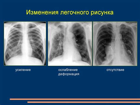 Аномалии развития легочной системы, вызывающие изменение рисунка в прикорневой зоне