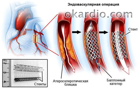 Аортокоронарное шунтирование: сущность операции и результаты лечения