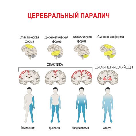 Атактический церебральный паралич