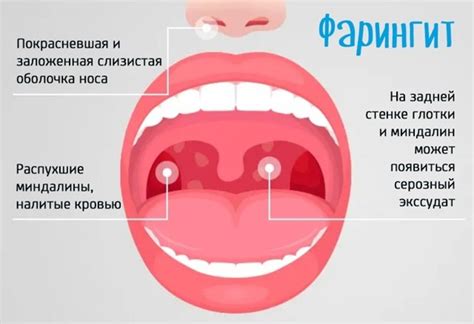 Белые комочки в горле: основные причины и лечение