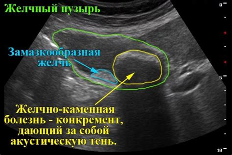 Билиарная взвесь в желчном пузыре