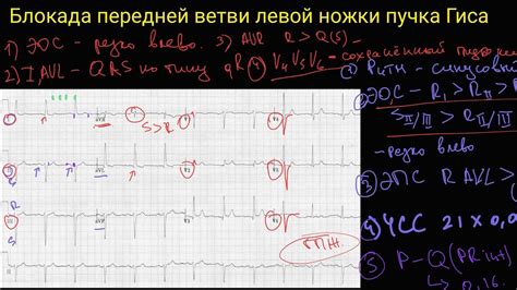 Блокада левой ветви ПГИС