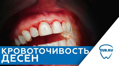 Болезненность и отечность десен