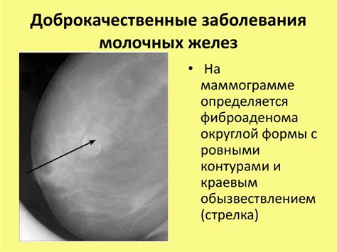 Болезни и инфекции молочных желез