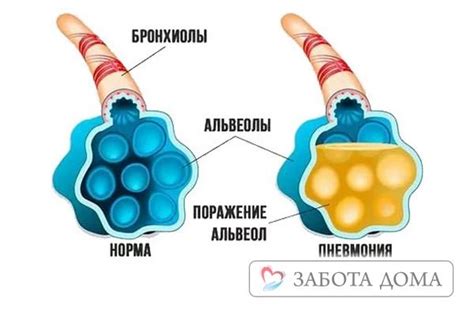 Болезни и нарушения в альвеолах легких