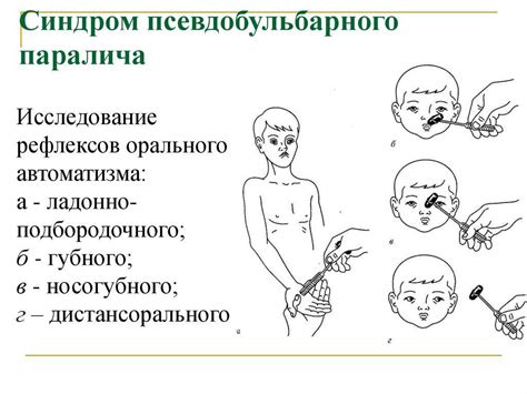 Бульбарный синдром: основные симптомы