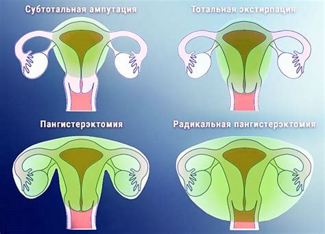 Важное решение: удаление матки или альтернативные методы лечения?