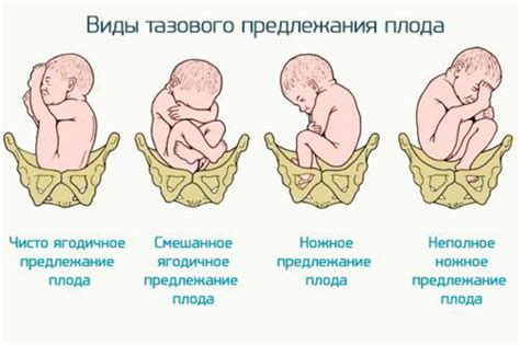 Важность определения положения плода