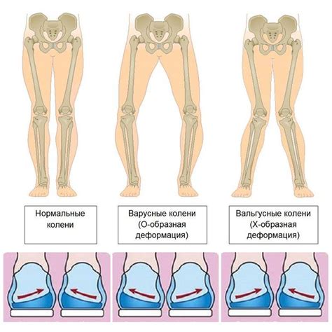 Вальгусная деформация у детей: причины, симптомы и методы лечения