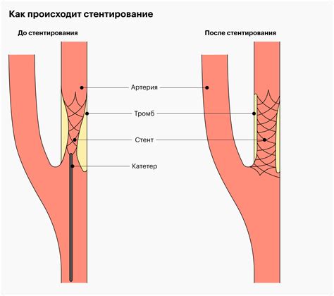 Варианты действий при неуспешном стентировании