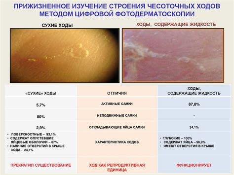 Варианты лечения чесотки на пятках: