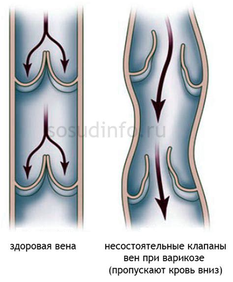 Венозный застой: что это и как он возникает?