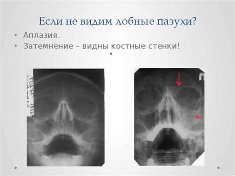 Вернуться к здоровью без жидкости в верхнечелюстной пазухе