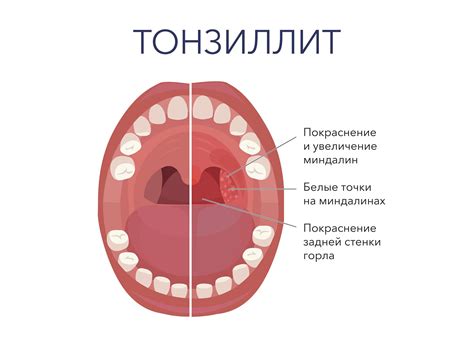 Вирусные инфекции и воспаления миндалин в горле