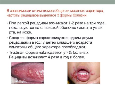 Вирусные инфекции и герпетический стоматит