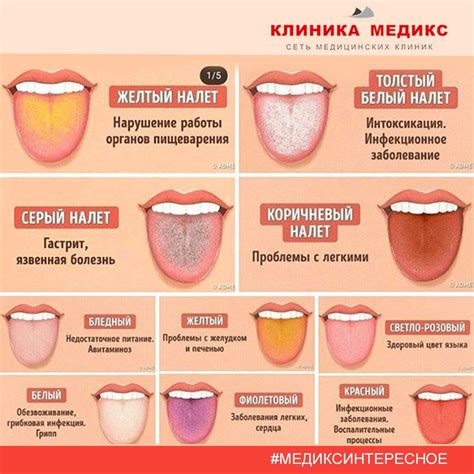 Влияние вирусов и бактерий на состояние языка