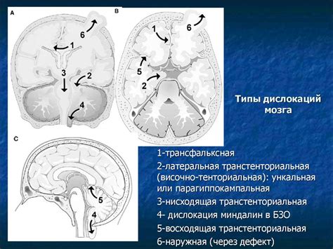 Влияние компьютерной томографии на диагностику головного мозга