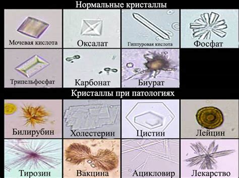 Влияние кристаллов в моче на здоровье