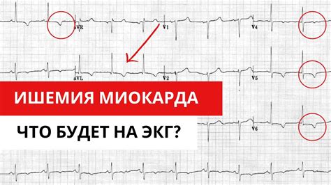 Влияние недостаточного вольтажа на результаты ЭКГ