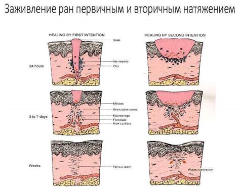 Влияние ожогов на регенерацию кожи