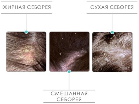 Влияние сухости кожи на образование перхоти