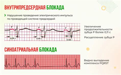 Внутрипредсердная блокада 1 степени