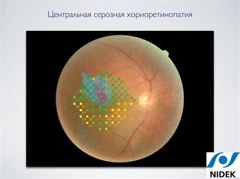 Возможности лечения венозного полнокровия сетчатки глаз