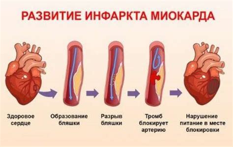 Возможные осложнения нестабильности миокарда