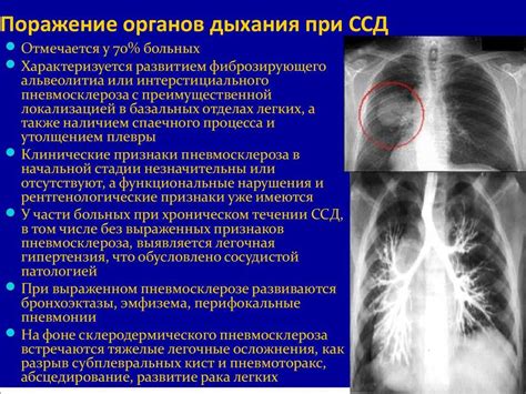 Возможные последствия диффузного пневмосклероза