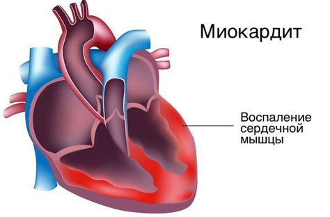 Возможные последствия замедления электрической систолы желудочков