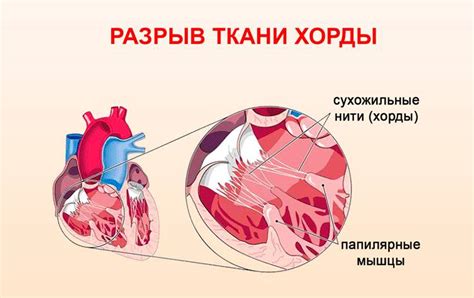 Возможные последствия и лечение дополнительных хорд в левом желудочке