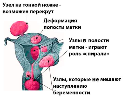 Возможные причины невозможности визуализации миоматозных узлов