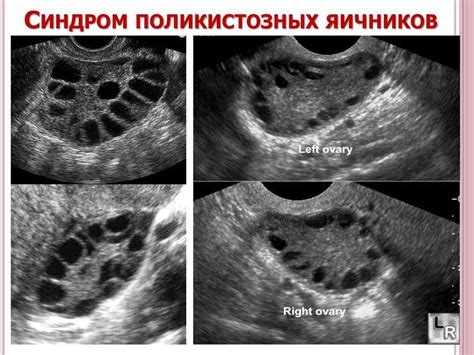 Возможные причины отсутствия фолликулов в одном яичнике