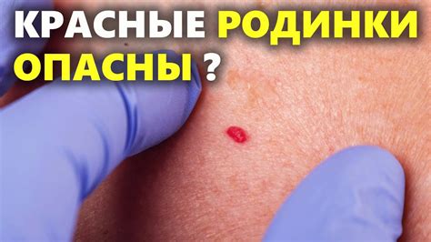 Возможные причины появления родинки на глазу у женщин