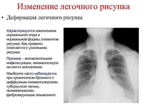 Возможные причины усиленного легочного рисунка