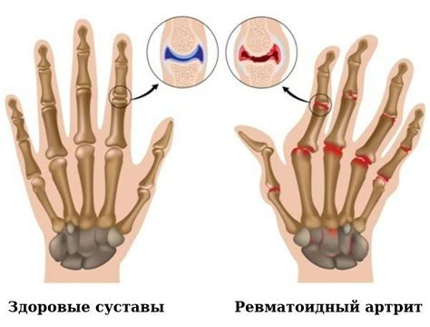 Воспаление и повреждение суставов