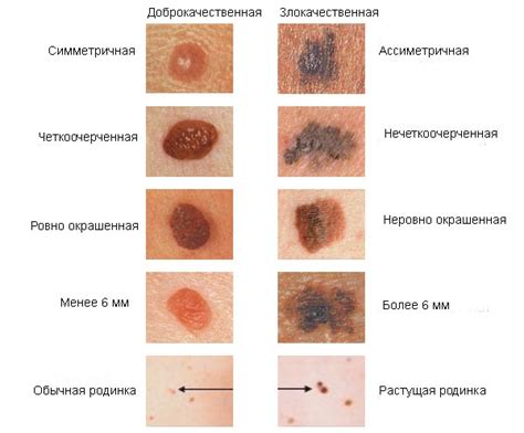 Вредные последствия от раскрытой родинки