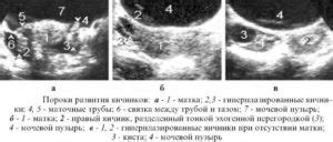 Врожденные аномалии развития яичников