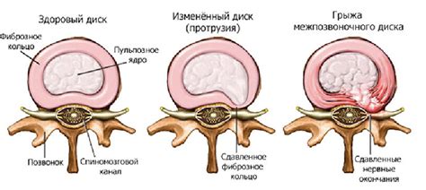 Выбор метода лечения грыжи позвоночника