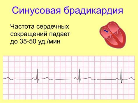 Выраженная синусовая аритмия