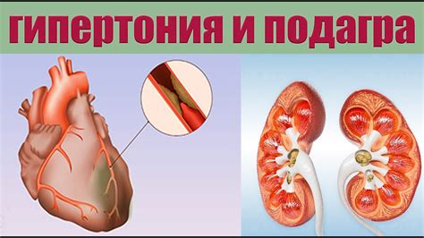 Высокий уровень мочевой кислоты