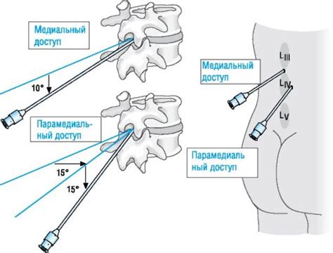 Высота блока при спинальной анестезии: