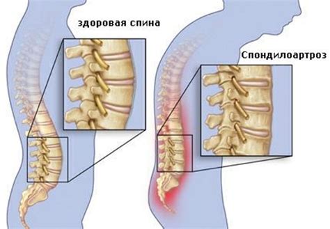 В чем причины смещения позвоночника