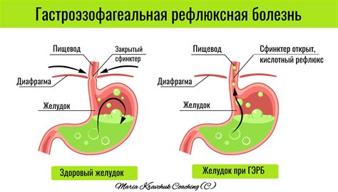 Гастроезофагеальный рефлюкс и кислотность