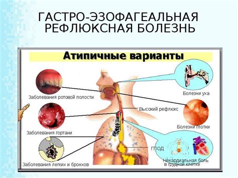 Гастроэзофагеальный рефлюкс