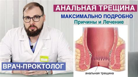 Геморрой и трещины в области прямой кишки