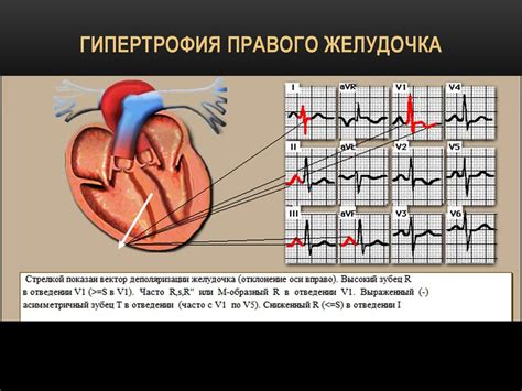 Гипертрофия миокарда: основные признаки на ЭКГ